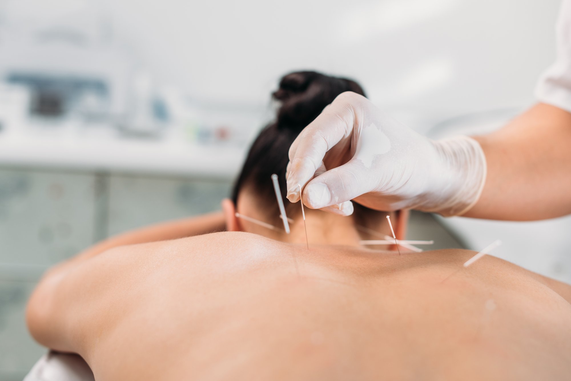dry-needling-milton-ga