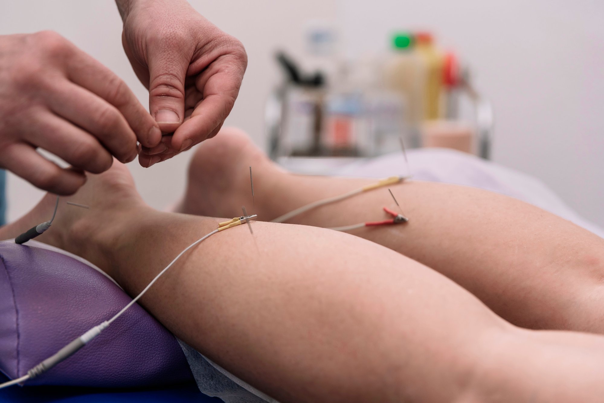 dry-needling-milton-ga
