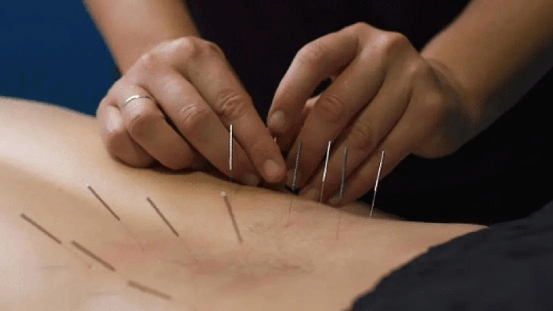 dry-needling-milton-ga